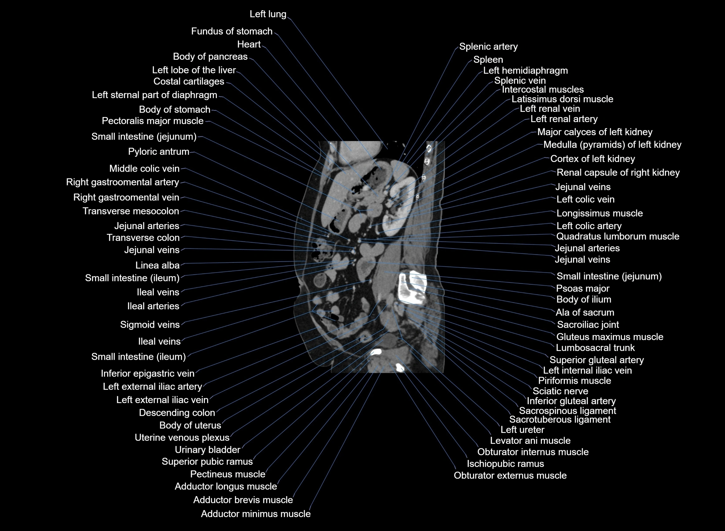 CT Abdomen sagittal cross sectional anatomy labelled radiology image -00044.webp